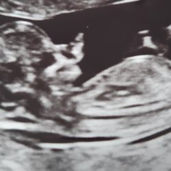 ECHOGRAPHIE